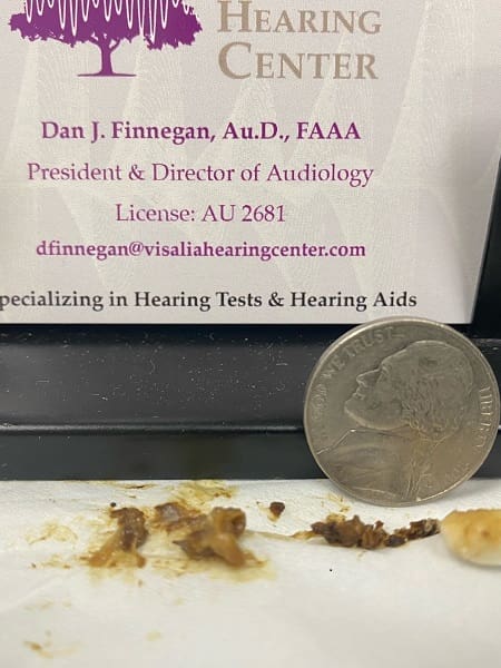 earwax-img-2025